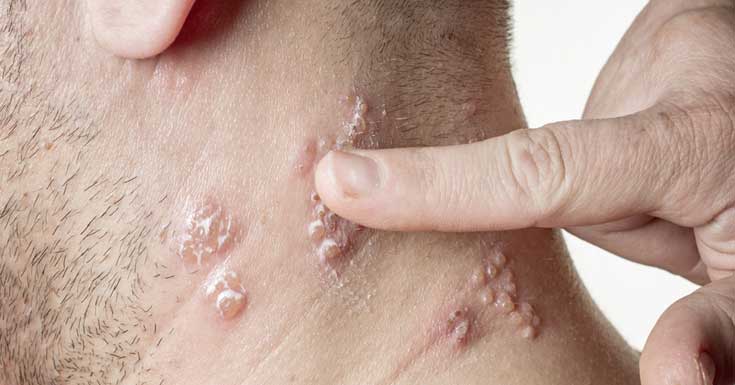 shingles Shingles
