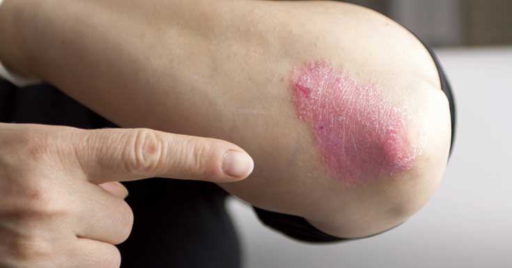 Skin Disorders