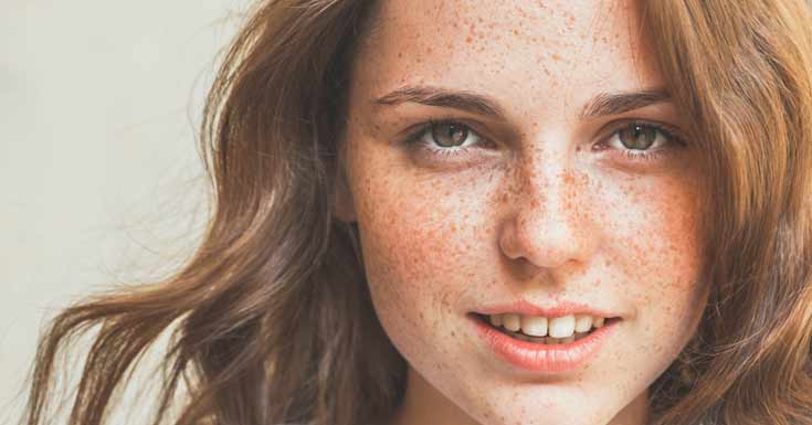 Worry About Moles and Freckles