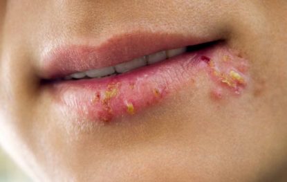 Alternative Ways to Treat Herpes