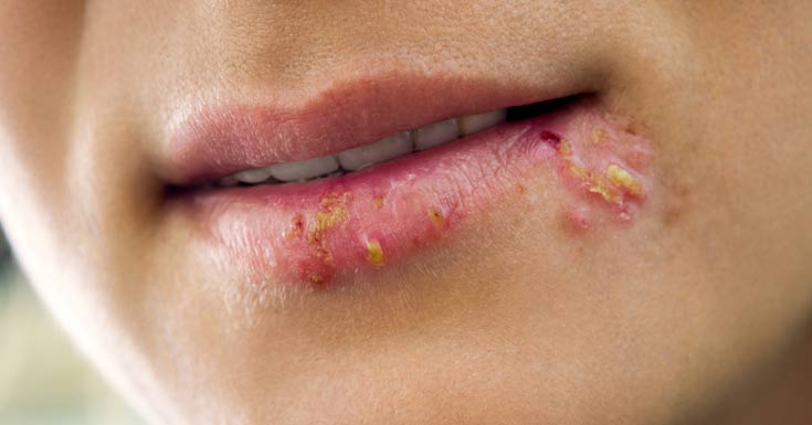 alternative-ways-to-treat-herpes Alternative Ways to Treat Herpes!