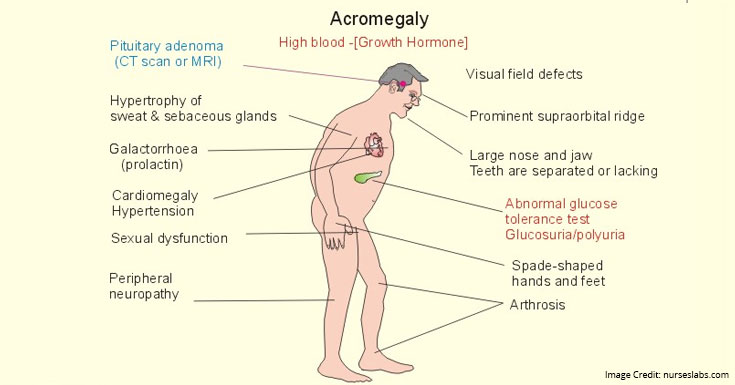 Hypersecretion of Growth Hormone Symptoms
