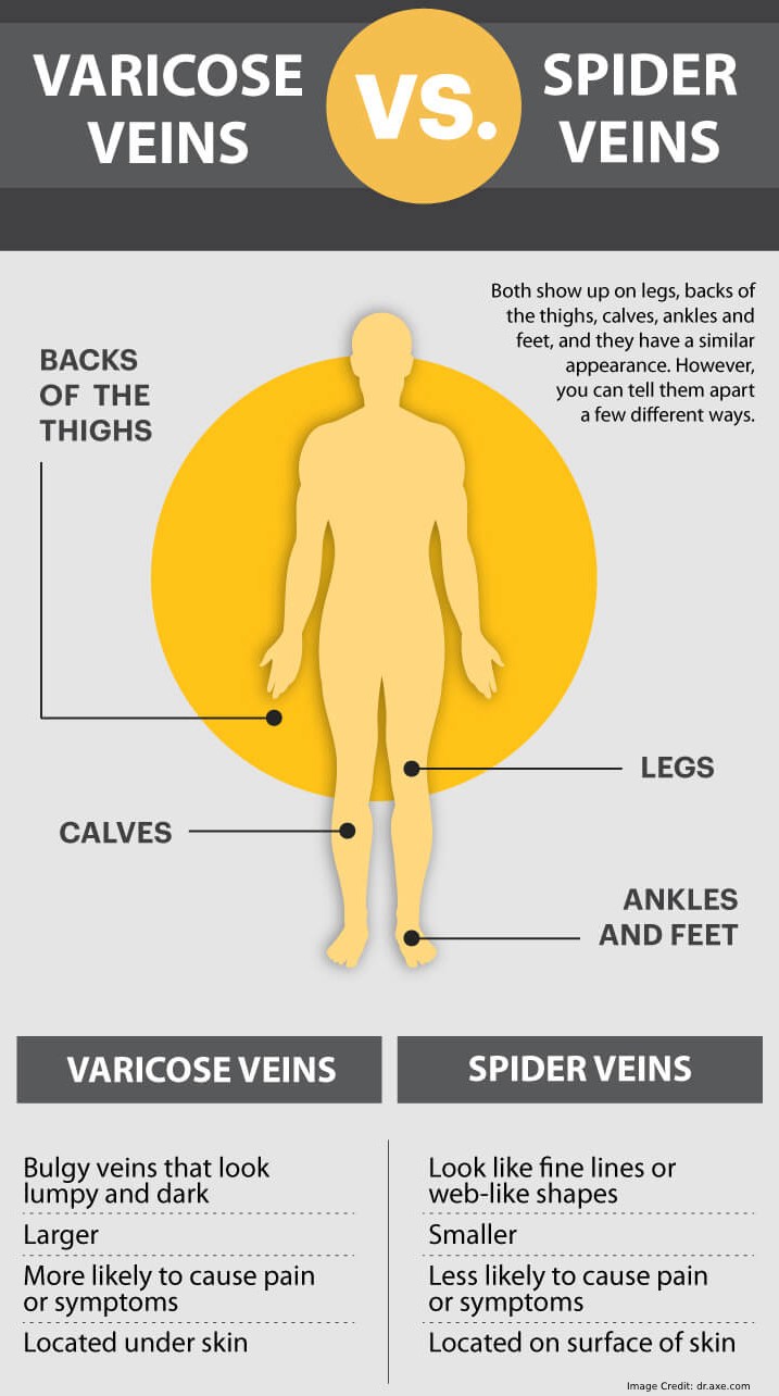 About Varicose And Spider