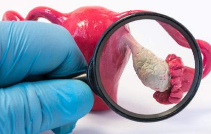 Cancer And PCOS- Know How PCOS Can Increase The Risk Of Cancer