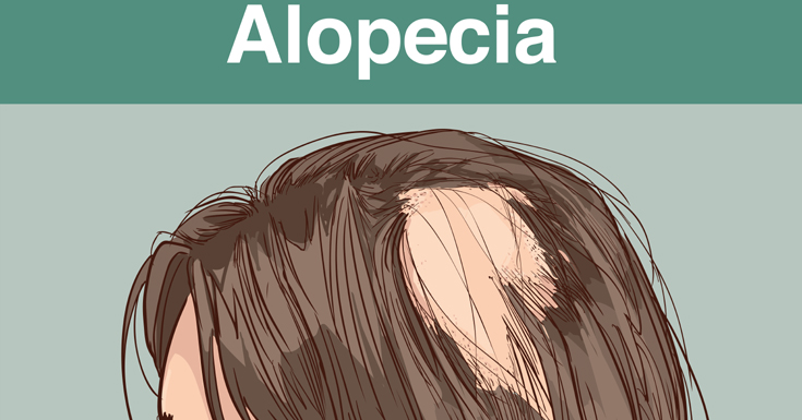 Alopecia Areata