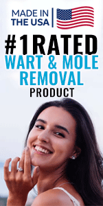 wart-mole-removal-reviews