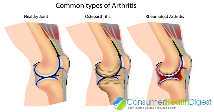 Common Types of Arthritis: Osteoarthritis, Rheumatoid Arthritis & More