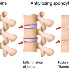 Ankylosing Spondylitis