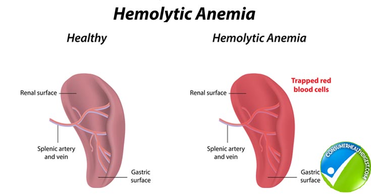 What are some symptoms of hemolytic anemia?