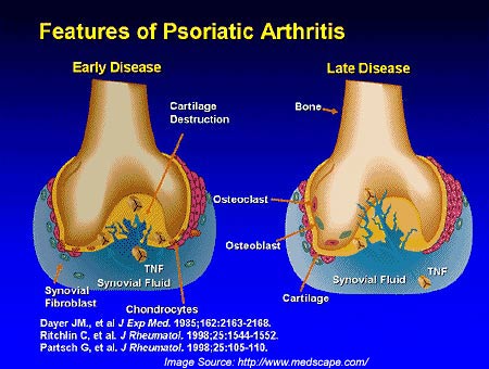 Psoriasis - Treatment - NHS Choices