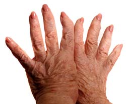 What is schleroderma?