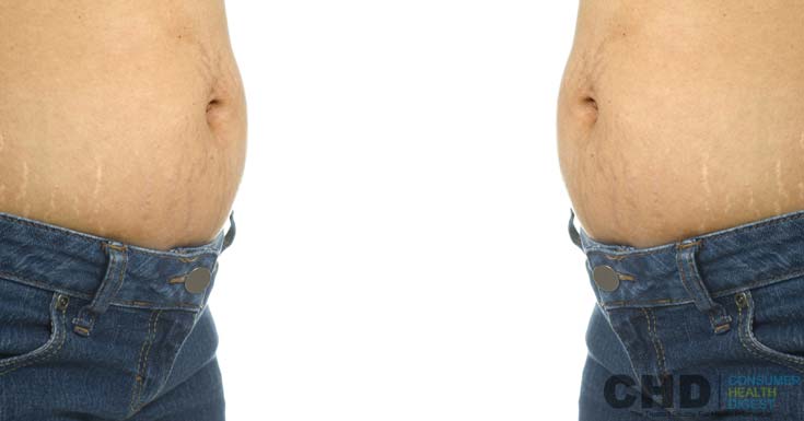 weight loss stretch marks