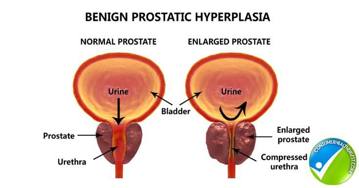Prostatilén a prostatitis alatt. Prosztata hiperplázia ciszták