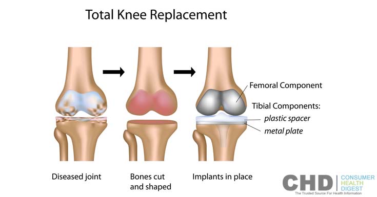 knee or hip replacement