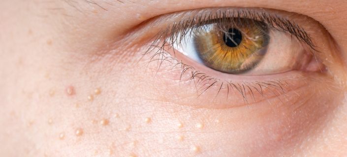 Under Eye Milia – How To Get Rid of Milia Under the Eyes
