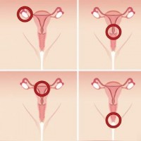 Vaginal Discharge