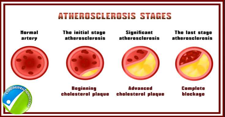 Heart Diseases