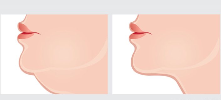 Sagging Chin – How to Tighten Without Surgery?
