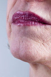 Wrinkles and Lines Around the Mouth