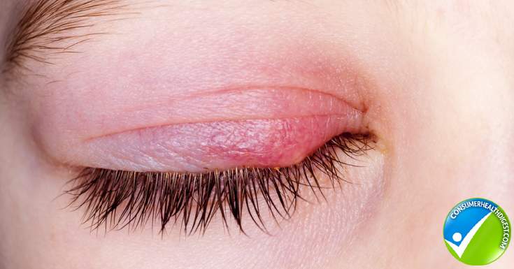 eye gland infections