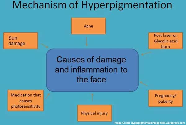 Hyperpigmentation Treatments, Causes & Photos - RealSelf