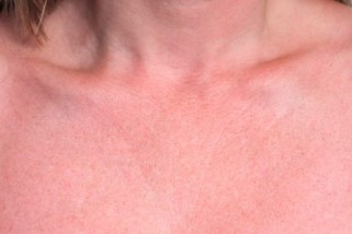 What Causes Skin Discoloration on Neck and Chest? Know Here!