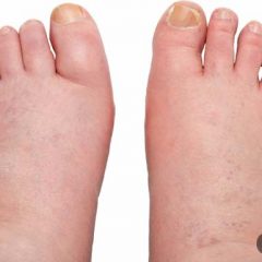 Swollen Feet and Water Retention