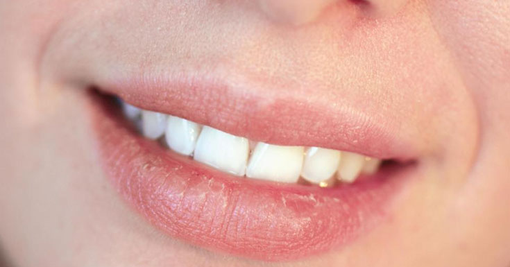 Itchy Lips: Symptoms, Causes &  land house Remedies