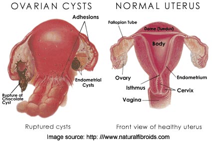 Leaking Ovarian Cyst