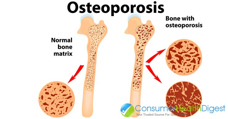 What causes degenerative bone loss?