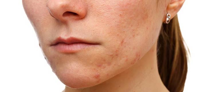 Acne Scars: What Is It And How To Get Rid Of Acne Scars?