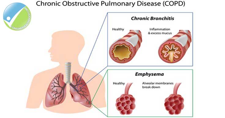 COPD Signs and Symptoms