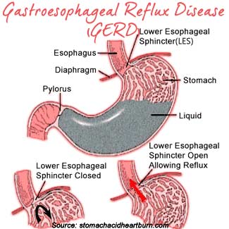 What are the symptoms of GERD?