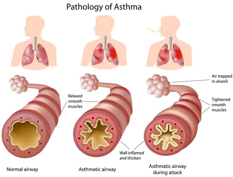 Pathology of Asthma
