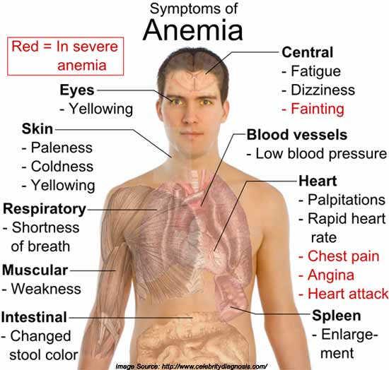 Is There A Link Between Iron Deficiency Anemia And Osteoarthritis is-there-a-link-between-iron-deficiency-anemia-and-osteoarthritis