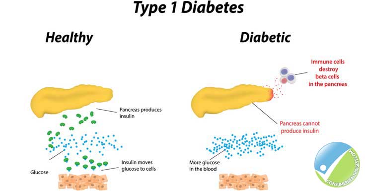 Diabetes: Types, Symptoms, Causes, Diagnosis, Treatments amp; More