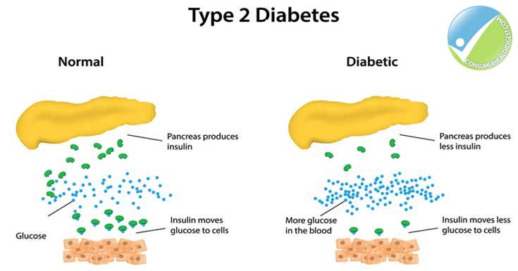 Diabetes: Types, Symptoms, Causes, Diagnosis, Treatments amp; More