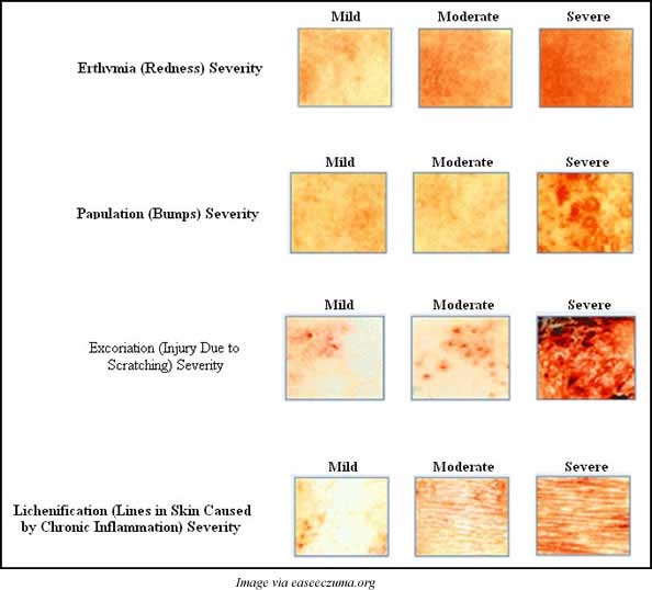 Eczema is a condition - WebMD