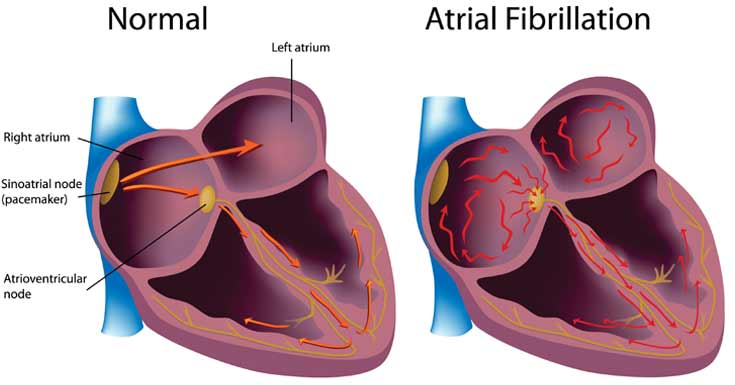 What kinds of foods can trigger atrial fibrillation?