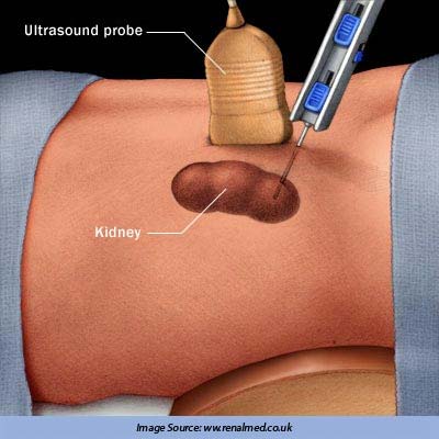 Biopsy