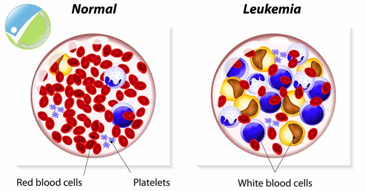 13 Interesting Facts About Leukemia