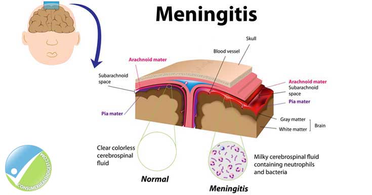 Meningitis