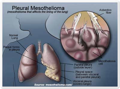 Mesothelioma Cancer: Causes, How You Get It & Risk Factors