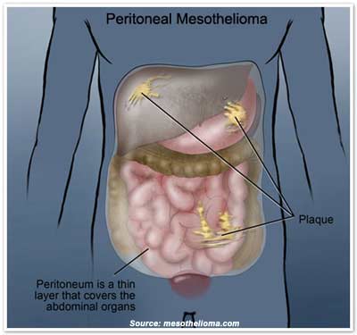 pembrolizumab first line mesothelioma