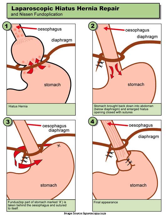 Hiatal Hernia Types Symptoms Causes Diagnosis And Treatment