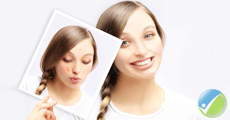 Failure To Treat Acne