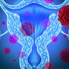 Ovarian Cancer