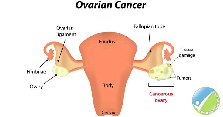What causes ovarian cancer?