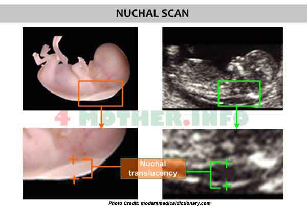 The nuchal scan (nt scan) is a screening done during an antenatal ultrasoun...