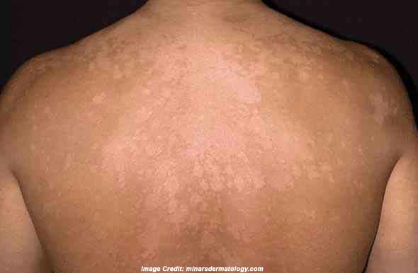 Tinea Versicolor: Causes, Symptoms, Treatment | Everyday ...